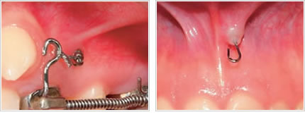 Curso de Microimplantes en Ortodoncia y Rehabilitación Oral