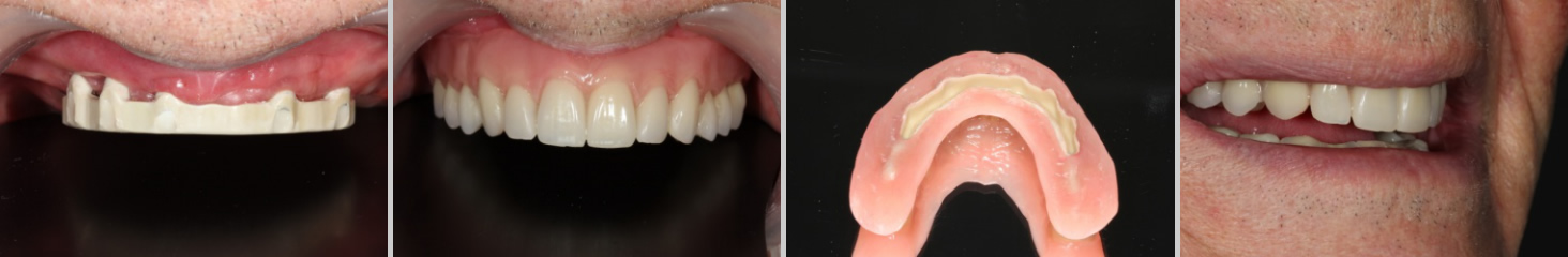 Caso clínico: Prótesis dentales sobre implantes libres de metal