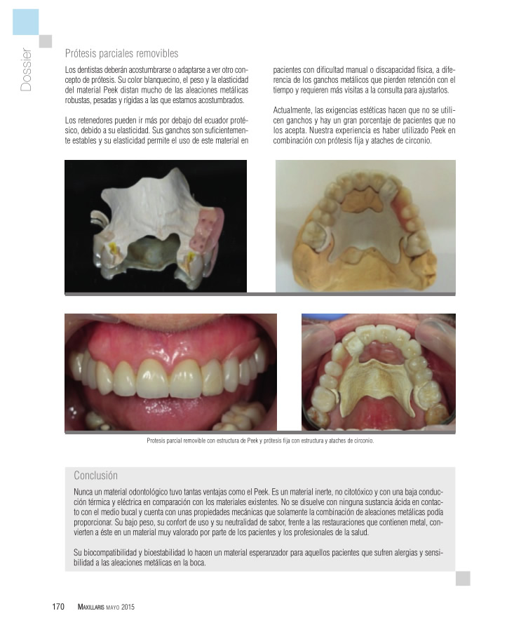  Peek, alternativa a aleaciones metálicas en la boca. Odontología sin metal