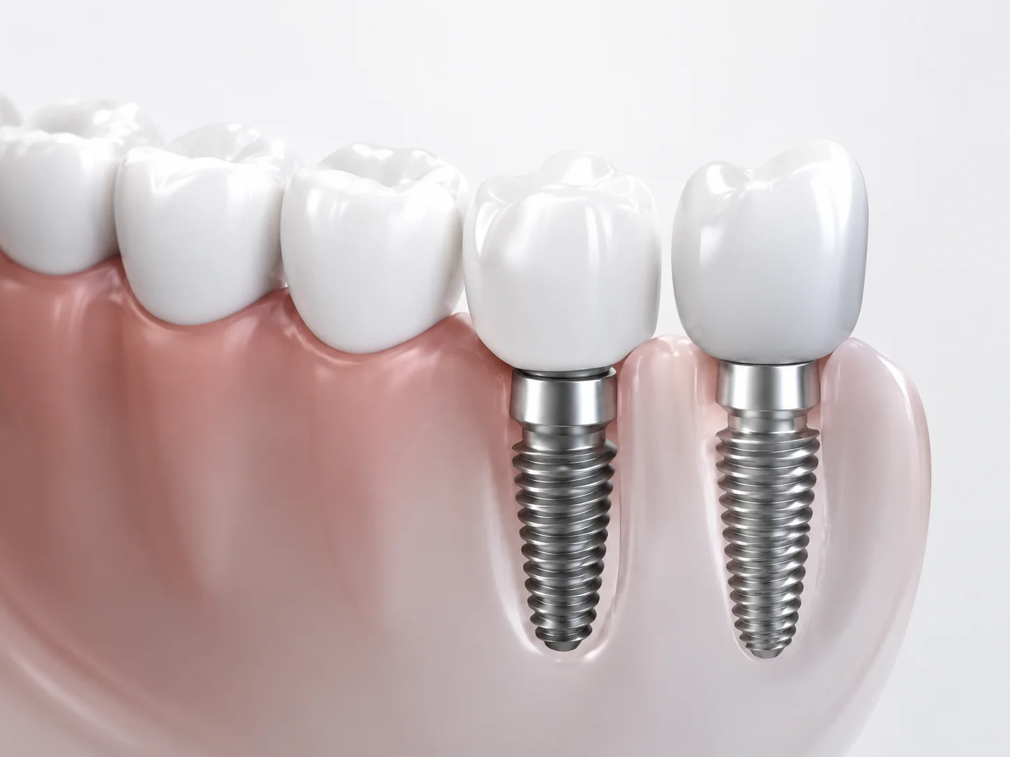 Implantología dental y cirugía oral con láser en Clínica CIROM, Murcia y Alicante