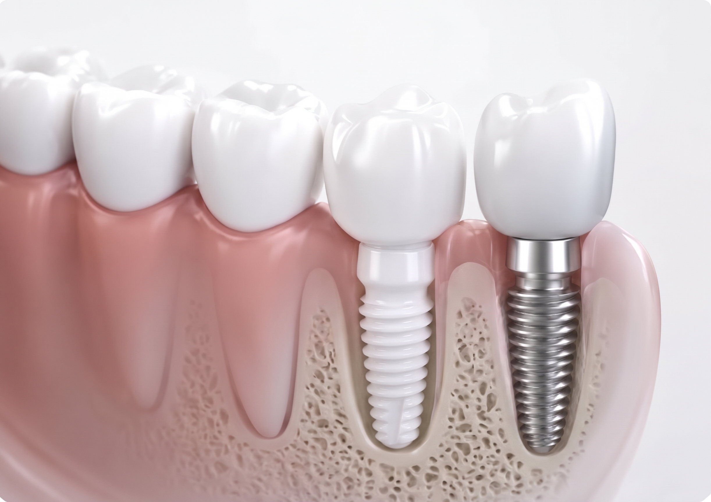 Implantología dental y cirugía oral con láser en Clínica CIROM, Murcia y Elche en Alicante